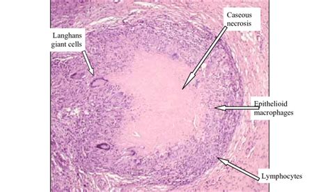 Microscopic Appearance Of Caseous Necrosis A Well Formed Granuloma