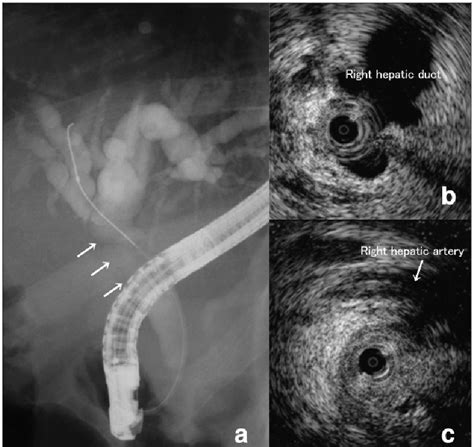 Ercp Intraductal Us Findings A Ercp Image There Is Severe Stricture