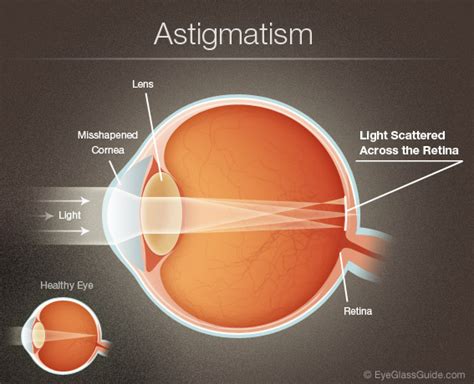 Astigmatism Symptoms Astigmatism Eyeglasses Eyeglass Guide