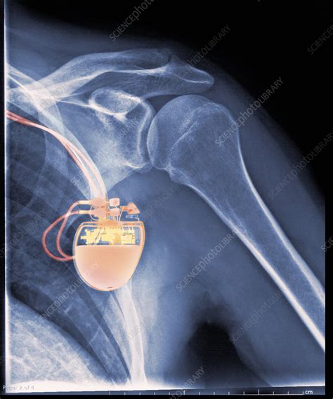 When it detects a very fast, abnormal heart rhythm, it delivers energy to the heart muscle. Implantable Defibrillator (Pacemaker) - Stock Image - C004 ...