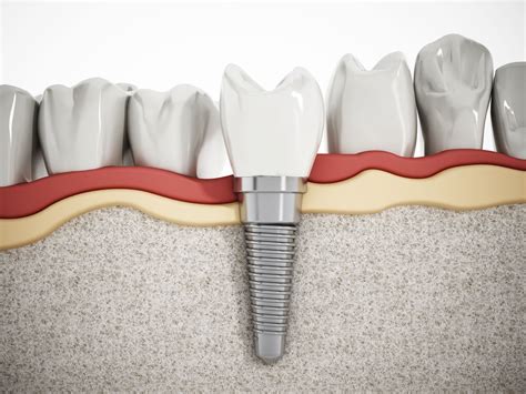 ¿pueden Dar Problemas Los Implantes Dentales