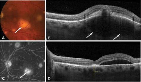Fundus Photography A Fluorescein Angiography C And Edi Oct B And