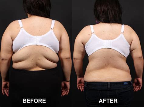 bra line back lift 13 bizarre but popular plastic surgery procedures pictures cbs news