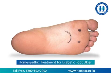 Diabetic Foot Ulcer Home Treatment