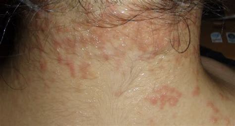 Eczema Rash On Back Dengan Gambar