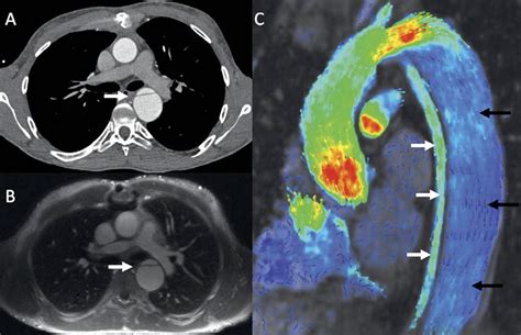 Cross Sectional Imaging Of Thoracic Traumatic Aortic Injury Vasa