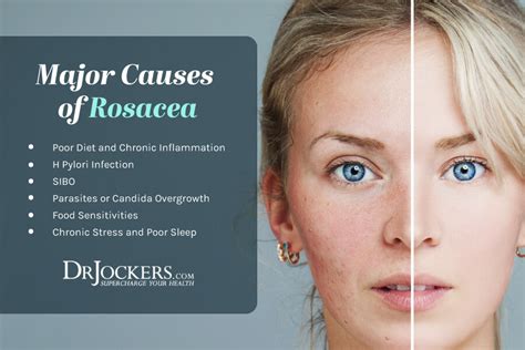 Rosacea Causes And Natural Support Strategies