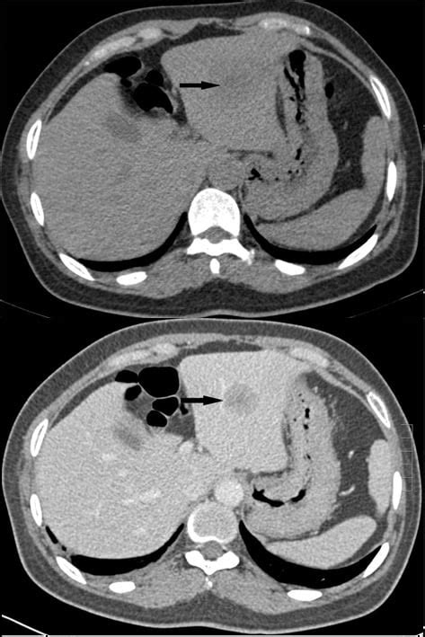 Clinical Question What Is The Role Of Contrast In Abdominal Ct For