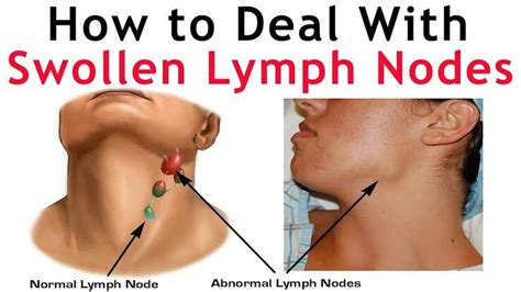 Swollen Lymph Nodes S Facts Best Ear Nose Throat Ent Doctor Nyc My XXX Hot Girl