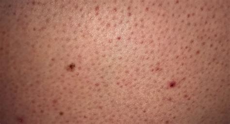 Keratosis Pilaris Or Chicken Skin All You Need To Know About This