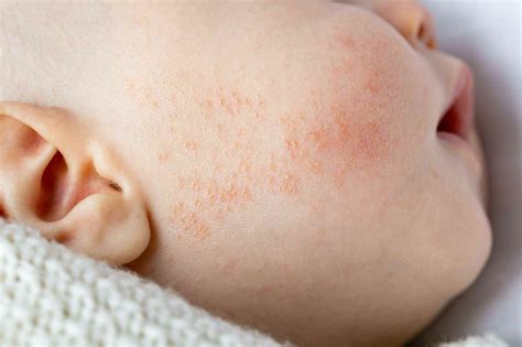 Alergi Pada Anak Kenali Jenis Dan Gejalanya