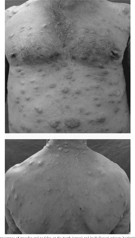 Figure 1 From Nodular Secondary Syphilis Simulating Lepromatous Leprosy