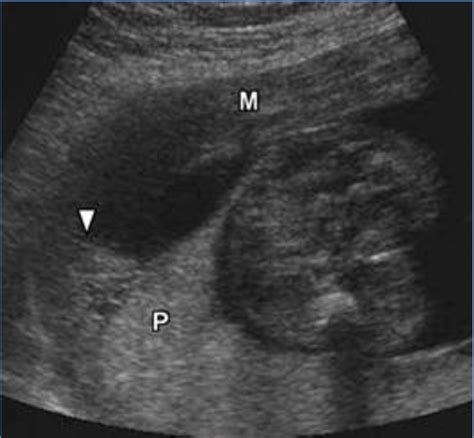 Sonographic Appearance Of A Retroplacental Hematoma With Hypoechoic