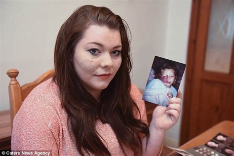 Woman Who Had Been Hiding Facial Birthmark For Years Finds Courage To