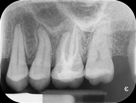Maxillary Sinusitis Of Endodontic Origin Mseo Seattle Endodontics