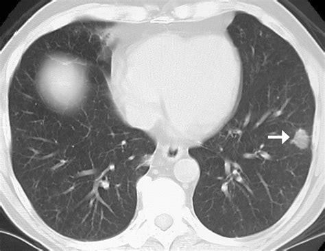 Pulmonary Cryptococcosis In Immunocompetent Patients Ct Findings In 12