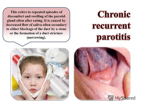 Презентация на тему Parotitis Mumps Parotitis Is An Inflammation