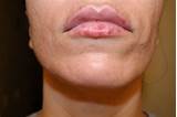 Pictures of Lip Injection Doctors