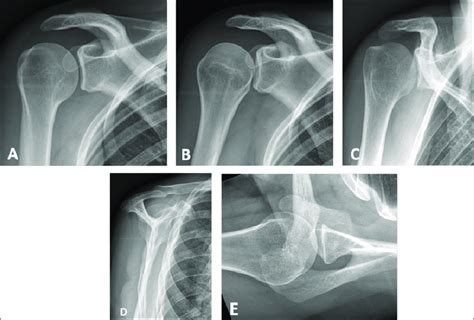 Ap Scapula Positioning