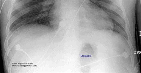 Rit Radiology Medial Displacement Of Gastric Air Bubble On