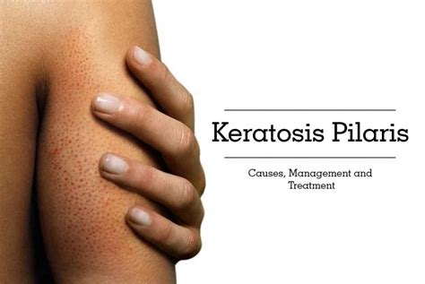 Keratosis Pilaris Everything You Should Know About It Dr Kashif S