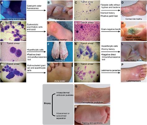 Tinea Pedis The Etiology And Global Epidemiology Of A Common Fungal