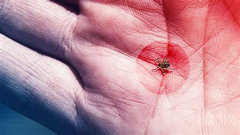 Tick Bite Symptoms To Know According To Experts