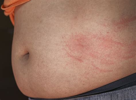 Why Do I Have A Rash On My Stomach After A C Section