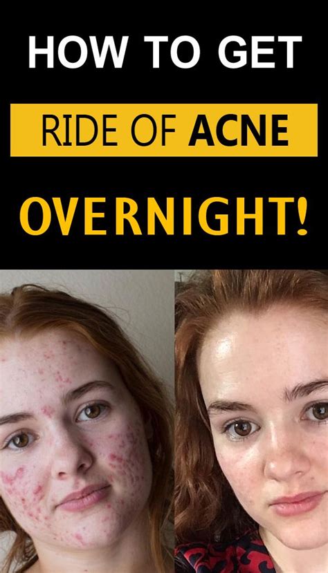 Best Home Remedy For Acne Overnight A Fit Life Style Acne Overnight