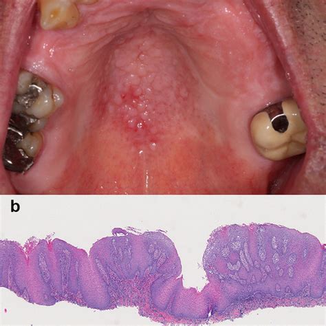 Lymphoid Hyperplasia Of The Lateral Lingual Tonsils The Multinodular