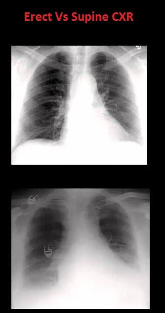 Understanding Basics Of Reading Chest X Ray Simply Explained