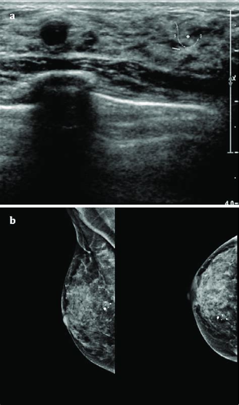 A Right Breast Ultrasound A 6 Mm Benign Cyst Can Be Observed In The