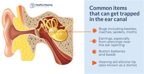 Got A Bug Or Something Else Stuck Or Trapped In Your Ear How To Remove