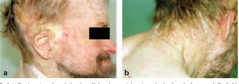 Figure 2 From Extensive Basal Cell Carcinoma And Disseminated Lesions