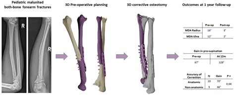 Children Free Full Text Accuracy Of 3d Corrective Osteotomy For