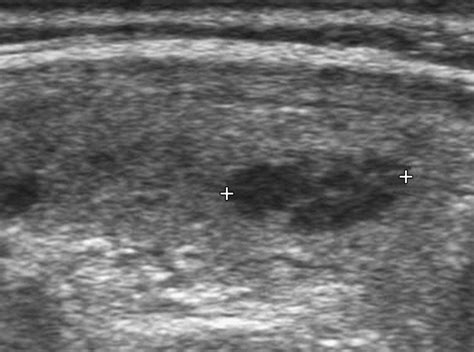 Hashimotos Thyroiditis Ultrasound