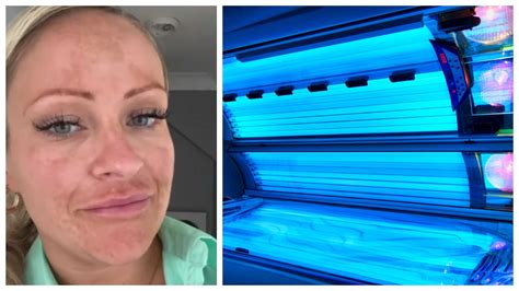 Woman Has Hole In Head After Developing Skin Cancer From Tanning Bed