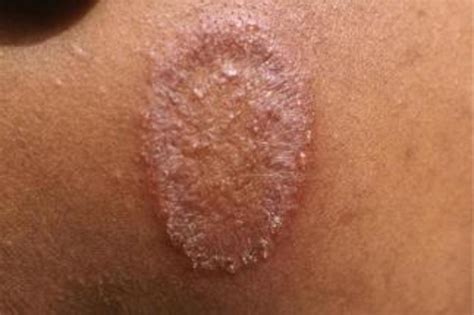 Bullseye Rashes Ringworm And Lyme Disease Differences Healdove