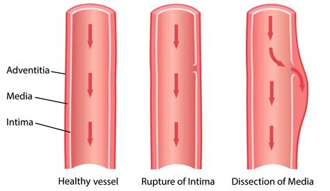 Aortic Dissection Management