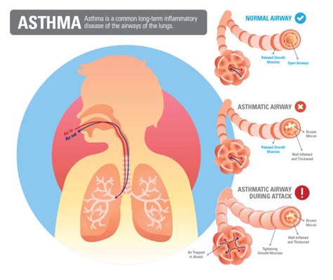 Asthma COPD Legacy For Airway Health