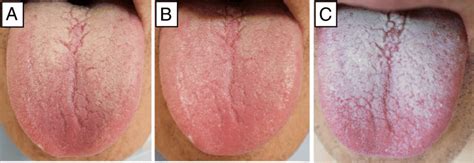 Macroscopic Features Of The Tongue Coating A Before Oral Care B After