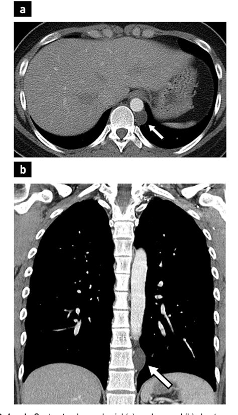 Figure 1 from Müllerian Cyst in Posterior Mediastinum in a Young Woman