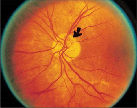 Learn about the causes, symptoms, diagnosis, treatment, and prevention of diabetic retinopathy. Diagnosis, Management, and Treatment of Nonproliferative ...