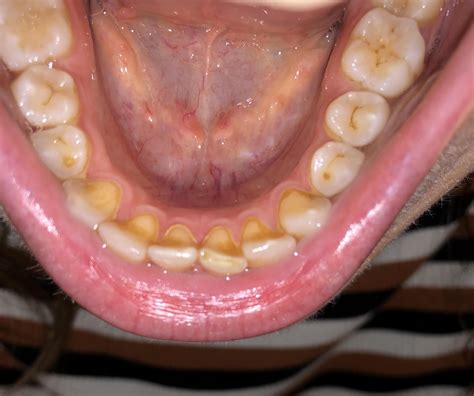 staining around edges of teeth possibly from chlorhexidine r dentistry