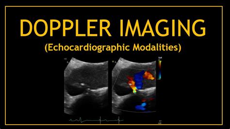 Doppler Imaging Echocardiogram Modalities Youtube