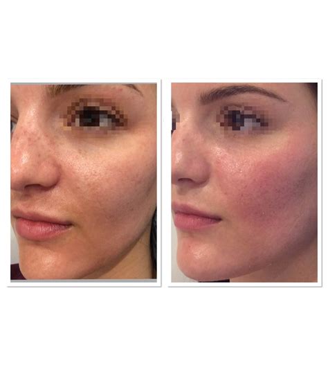 Acne Scar Before And After Treatment Parfaire Medical Aesthetics Pasadena