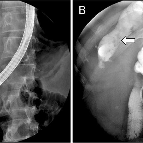 Ercp Findings A It Showed Fusiform Dilation Of The Common Bile Duct