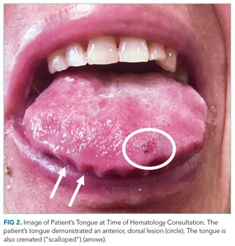 Tongue Disease