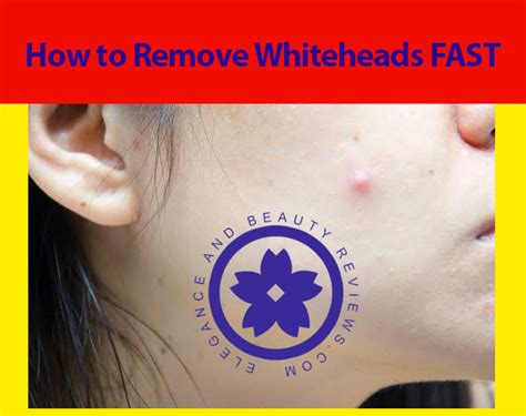 How To Get Rid Of Whiteheads Fast At Home Beauty Tips
