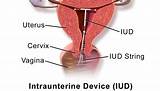 Information About Iud Birth Control Pictures
